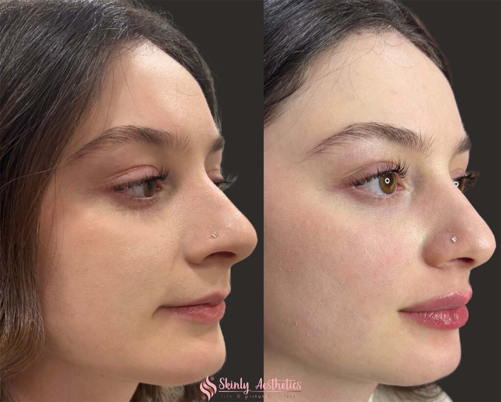 Here’s What To Know About Juvederm In NYC MedSpa Botox NYC